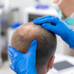 Hair Loss Treatment Kansas