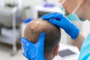 Hair Loss Treatment Kansas